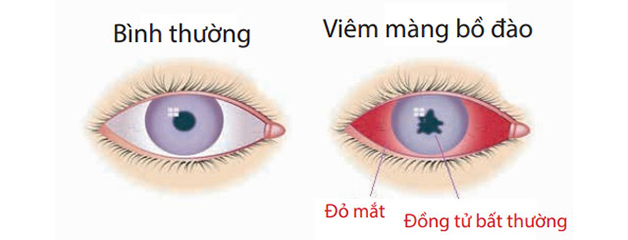 viêm màng bồ đào