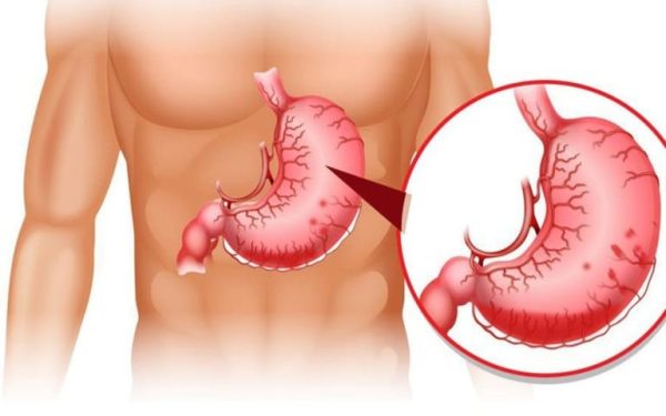 Biến chứng xuất huyết tiêu hóa