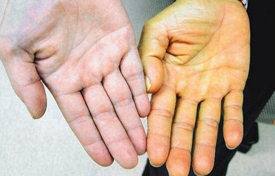 Da vàng nhợt là biểu hiện của ung thư gan
