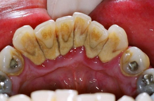 tác hại của cao răng