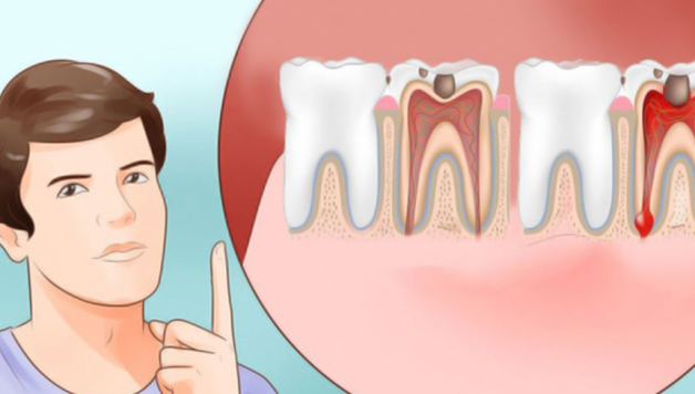 cách trị sâu răng tại nhà