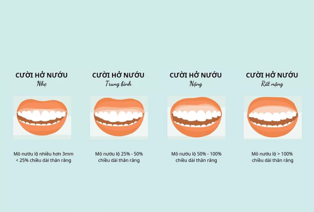 Cười hở lợi phải làm sao? Việc phải làm phụ thuộc vào nguyên nhân và mức độ cười hở lợi