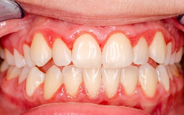 cách tri viêm lợi