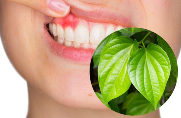 cách trị viêm lợi