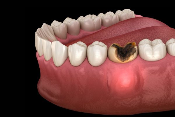 Tủy răng bị viêm không thể tự phục hồi, nguy cơ mất răng cao nên cần được điều trị tủy kịp thời