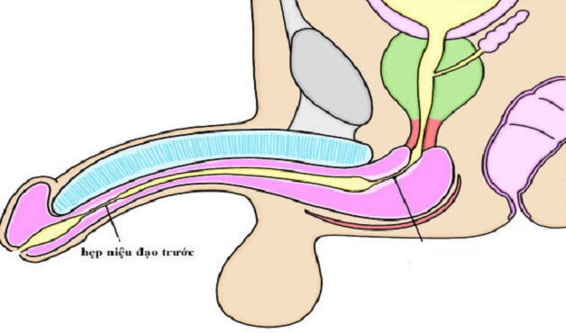 Tổng quan về bệnh sỏi niệu đạo trước