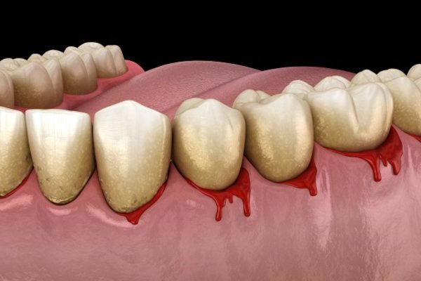Vi khuẩn có hại là tác nhân khiến mọi người gặp phải tình trạng hôi miệng
