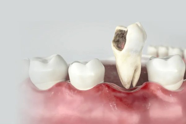 Hôi miệng là triệu chứng của bệnh gì theo các bác sĩ nha khoa là dấu hiệu của một số bệnh lý nha khoa, bệnh lý toàn thân