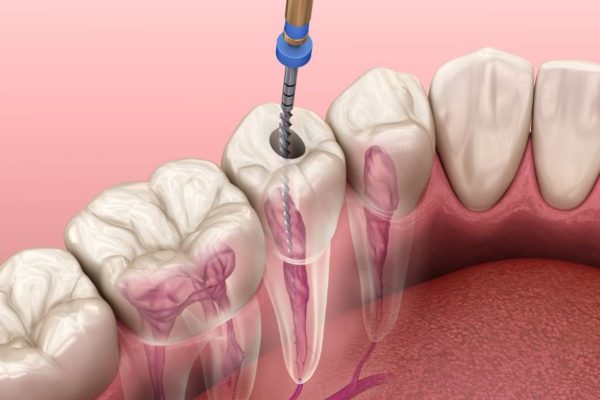 Phương pháp thường được áp dụng để chữa tuỷ chính là hàn trám ống tủy