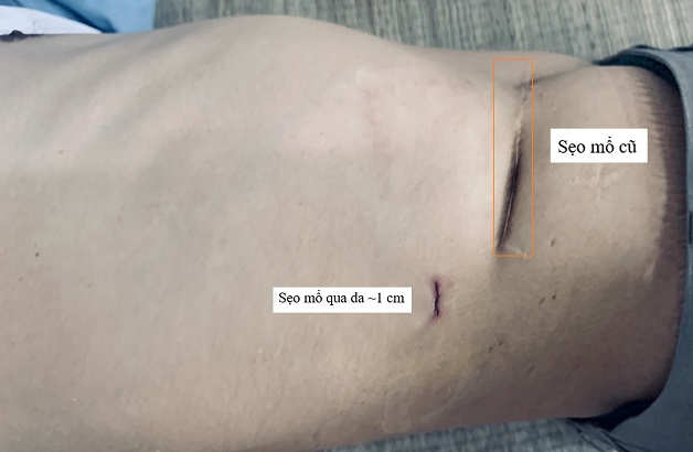 Phương pháp này để lại sẹo nhỏ hơn mổ mở