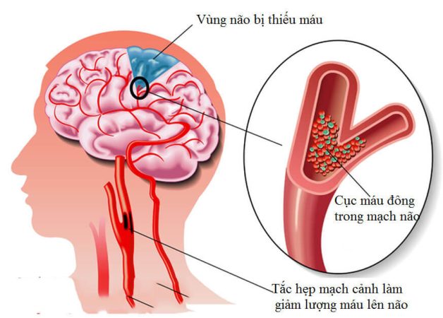 Đột quỵ thiếu máu não là dạng phổ biến nhất, cơn đột quỵ xảy ra khi khối máu đông hoặc mảng xơ vữa làm tắc nghẽn mạch máu đến não