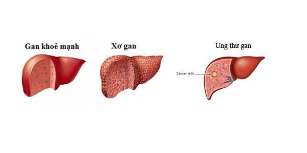 Ung thư gan xuất phát từ xơ gan