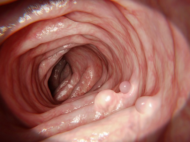 Polyp đại tràng là gì?
