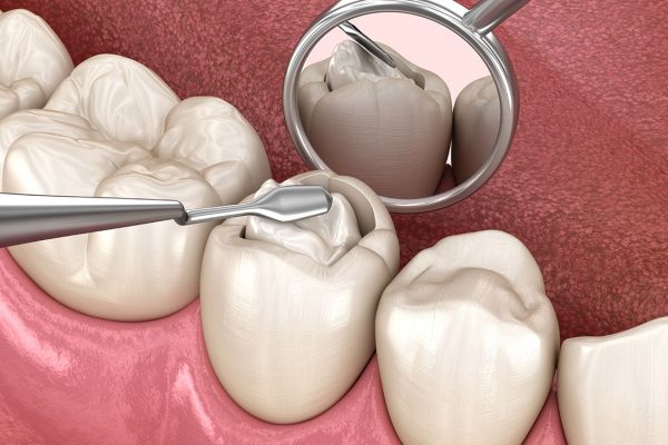 Hàn răng là kỹ thuật trám chất liệu đặc biệt vào vị trí răng bị khuyết thiếu để phục hình