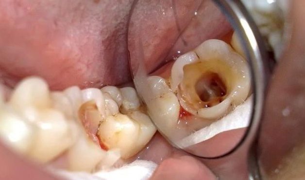 răng sâu bị vỡ