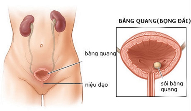 Sỏi bàng quang là bệnh lý thường gặp