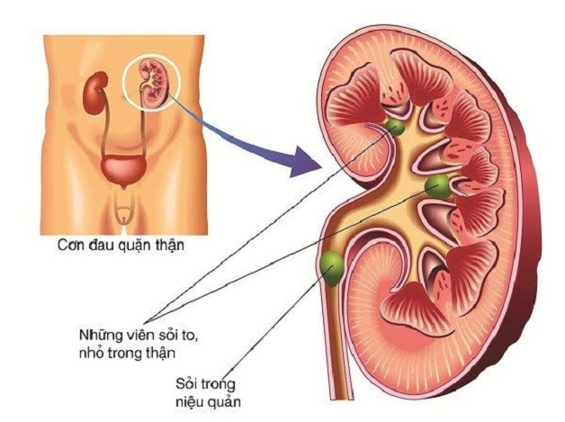 Sỏi niệu đạo do nhiều nguyên nhân gây ra