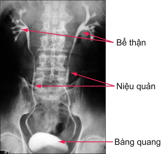 Chụp X-quang cho giúp xác định vị trí của sỏi