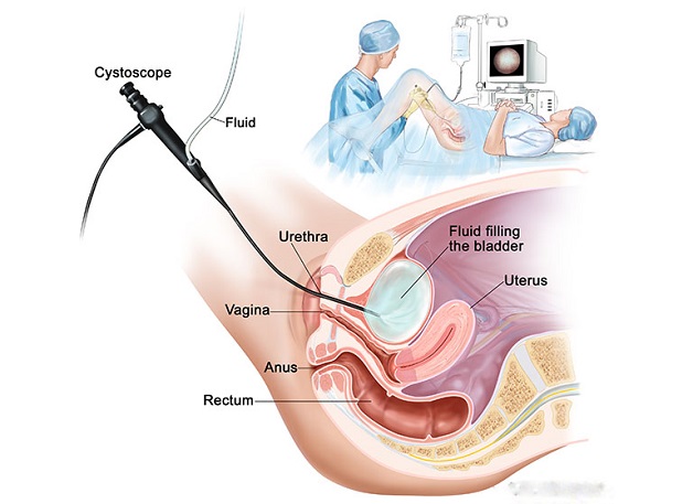 Phương pháp tán sỏi ngược dòng bằng laser