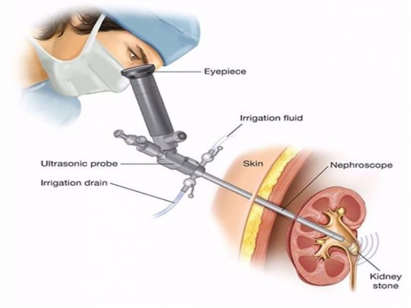 Tán sỏi qua da bằng đường hầm nhỏ là phương pháp hữu hiệu bậc nhất loại bỏ sỏi ở thận và niệu quản