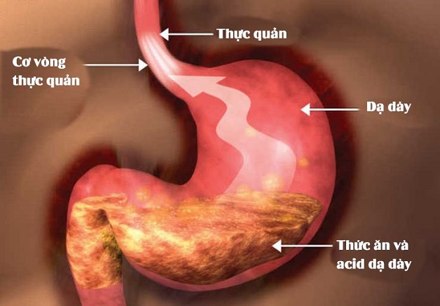 bệnh trào ngược dạ dày