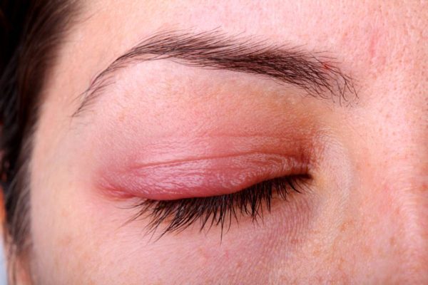 Viêm bờ mi là tình trạng viêm nhiễm xảy ra ở bờ tự do của mi mắt