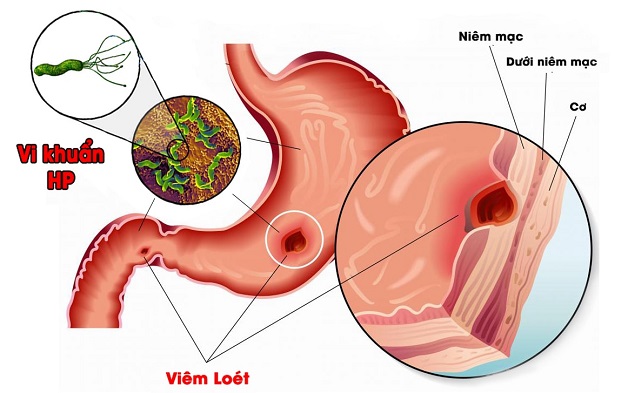 bệnh viêm dạ dày mãn tính do HP