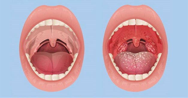 Viêm họng hạt là một dạng của viêm hầu họng mạn tính