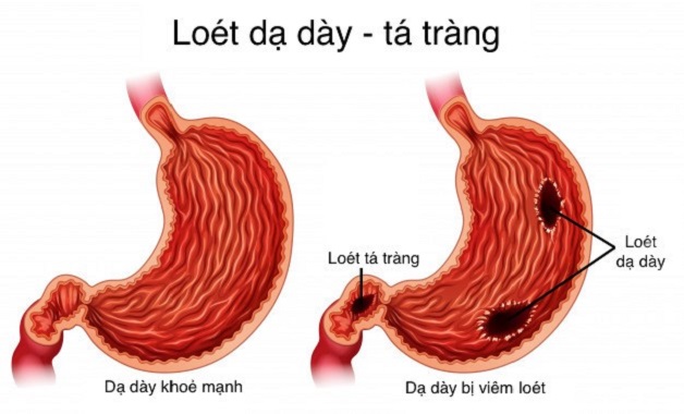 Viêm loét dạ dày là bệnh lý thường gặp