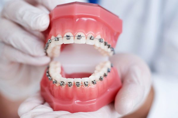 Viêm lợi khi niềng răng hình thành do mắc cài gây trầy xước, ảnh hưởng bởi bệnh lý nha khoa hoặc chế độ ăn uống kém khoa học