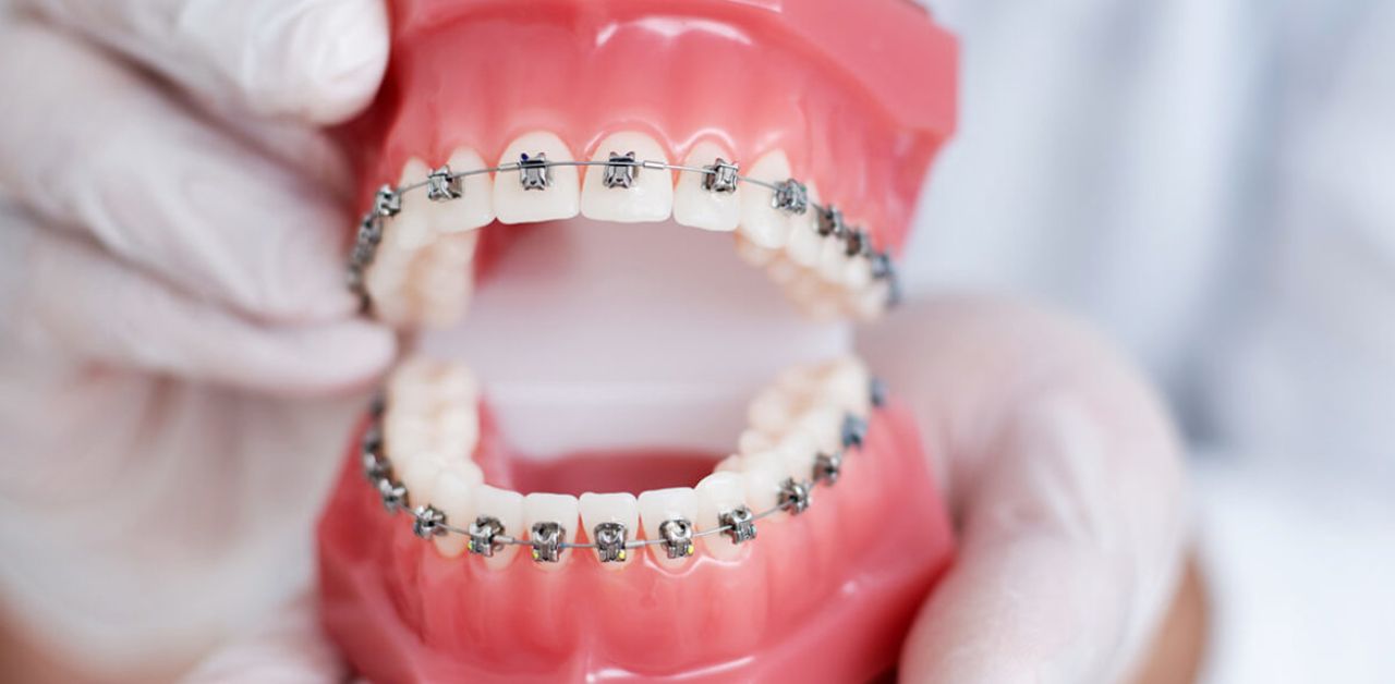 Viêm lợi khi niềng răng: Nguyên nhân và cách điều trị