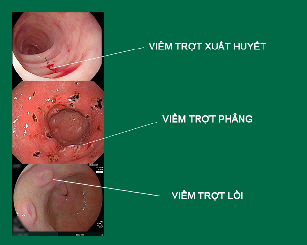 Các dạng viêm trợt hang vị dạ dày