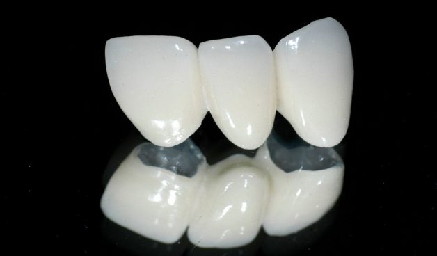 Phục hình cầu răng sứ có tính thẩm mỹ cao