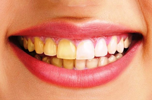 Bọc răng sứ có uống cà phê được không? Được nhưng nên hạn chế