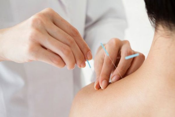 Châm cứu là một trong các phương pháp điều trị cho bệnh nhân thoái hoá đốt sống cổ