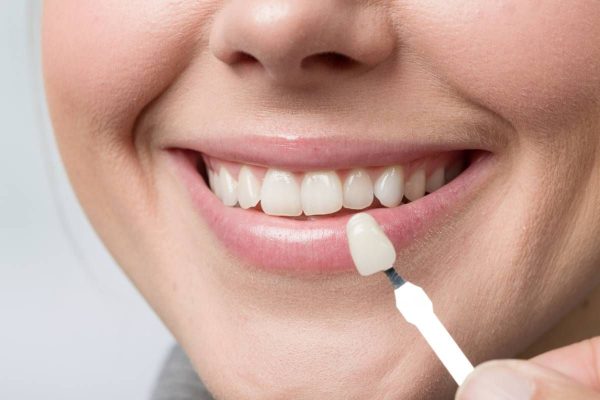 Mọi người có thể sở hữu nụ cười tự tin rạng ngời nhờ hàm răng trắng sáng, đều đẹp sau khi dán veneer