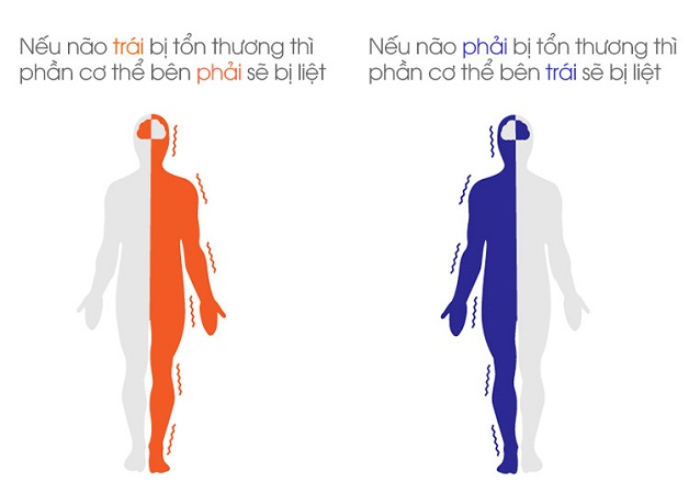 Liệt nửa người do tai biến mạch máu não