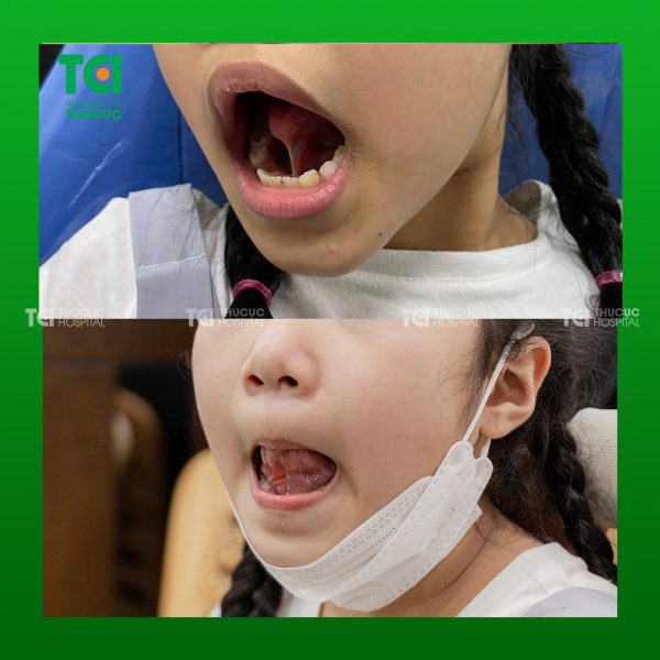 dính thắng lưỡi có nguy hiểm không
