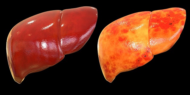 Gan nhiễm mỡ cấp độ 1 là gì?