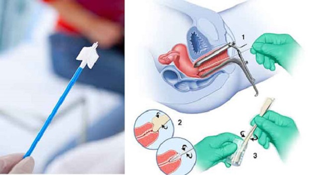 tầm soát ung thư cổ tử cung quan trọng ra sao