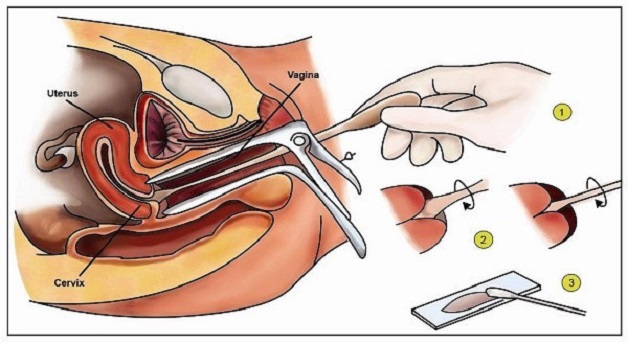 quy trình thực hiện xét nghiệm HPV