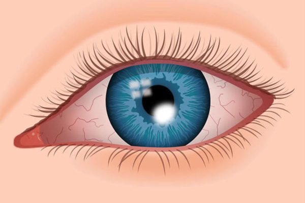 Loét giác mạc là tình trạng giác mạc bị tổn thương khi tiếp xúc với bụi bẩn, đất cát, dị vật, dụi mắt… và bị nhiễm trùng