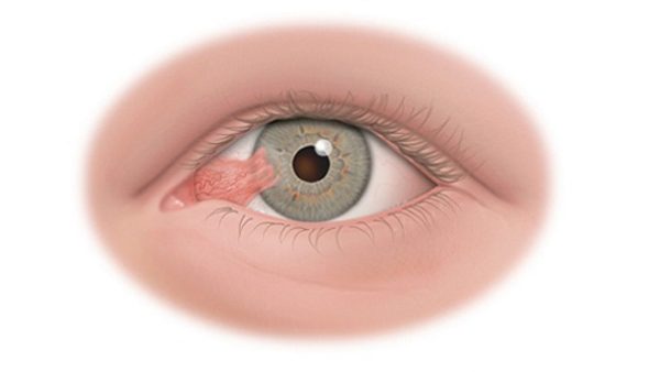mắt bị mộng thịt