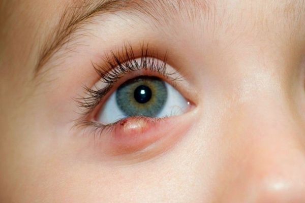 Mắt lên lẹo là tình trạng nhiễm khuẩn cục bộ và sưng đỏ xung quanh bờ mi mắt