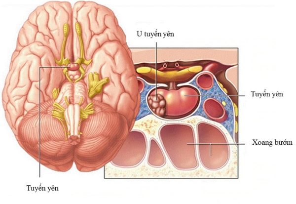 u tuyến yên nguyên nhân gây mất ngủ kéo dài
