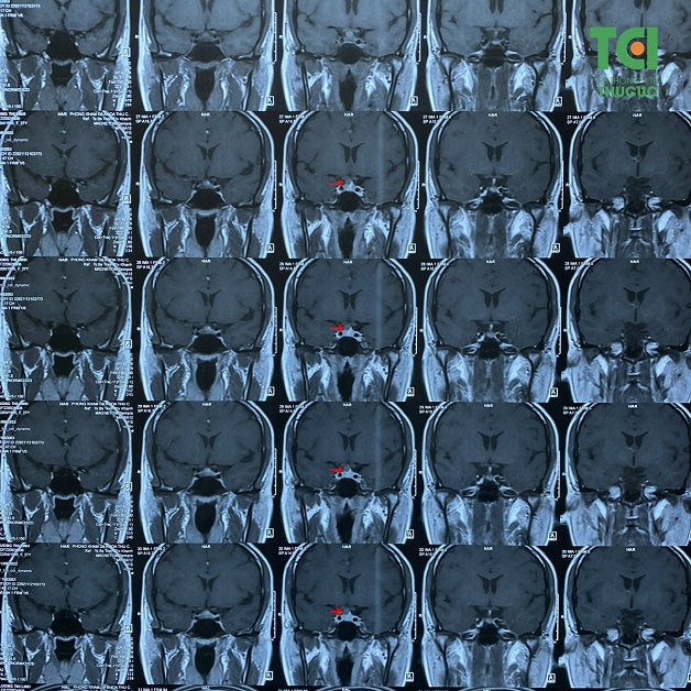 u tuyến yên gây mất ngủ kéo dài trên phim chụp MRI
