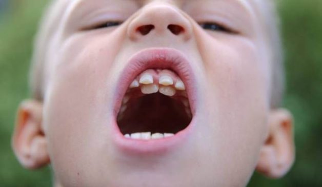 hi số lượng răng vượt quá 32, bạn được xác định là có răng thừa.