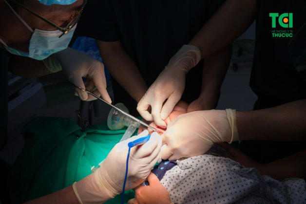 Bé bị dính thắng lưỡi nên được phẫu thuật càng sớm càng tốt