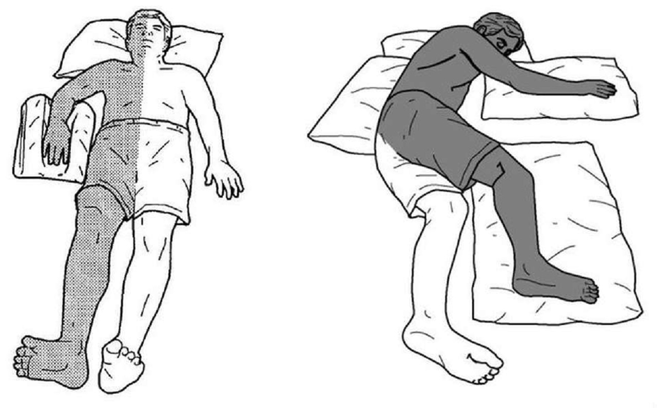 Minh hoạ về liệt nửa người