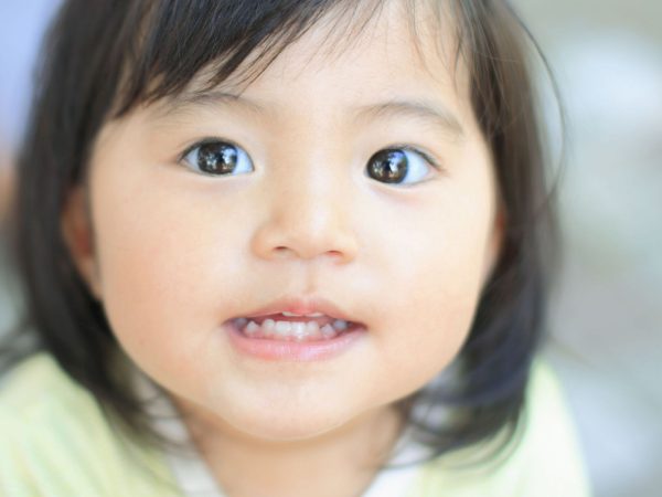 tật mắt lác